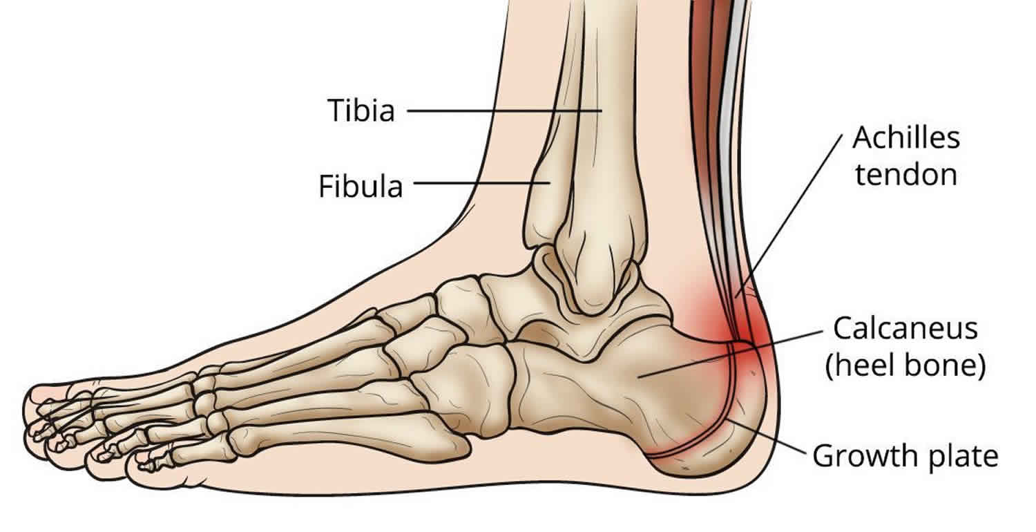 Children S Heel Pain Sever S Disease Dr Howard Green