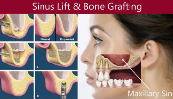 sinus lift