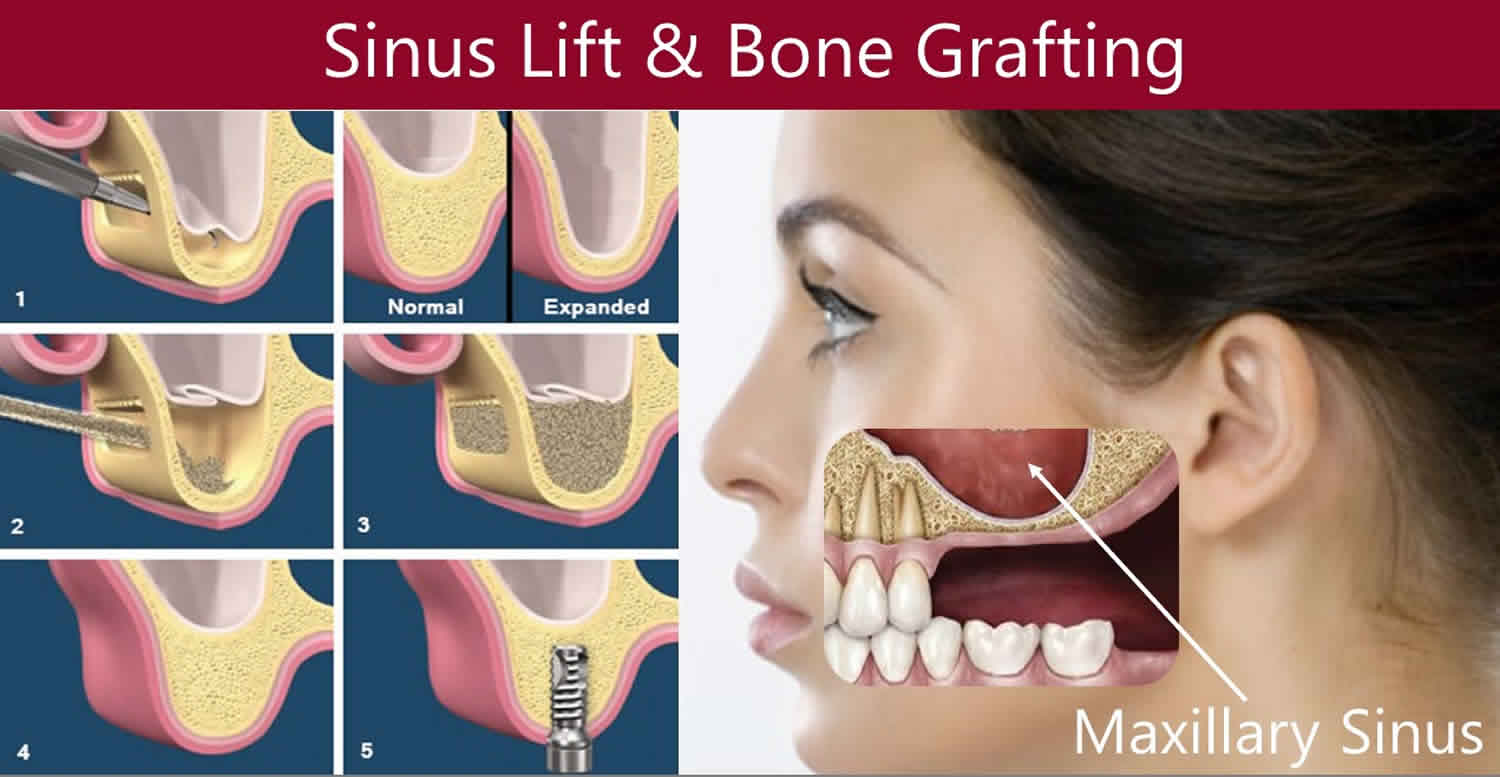 sinus-lift