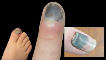 subungual hematoma