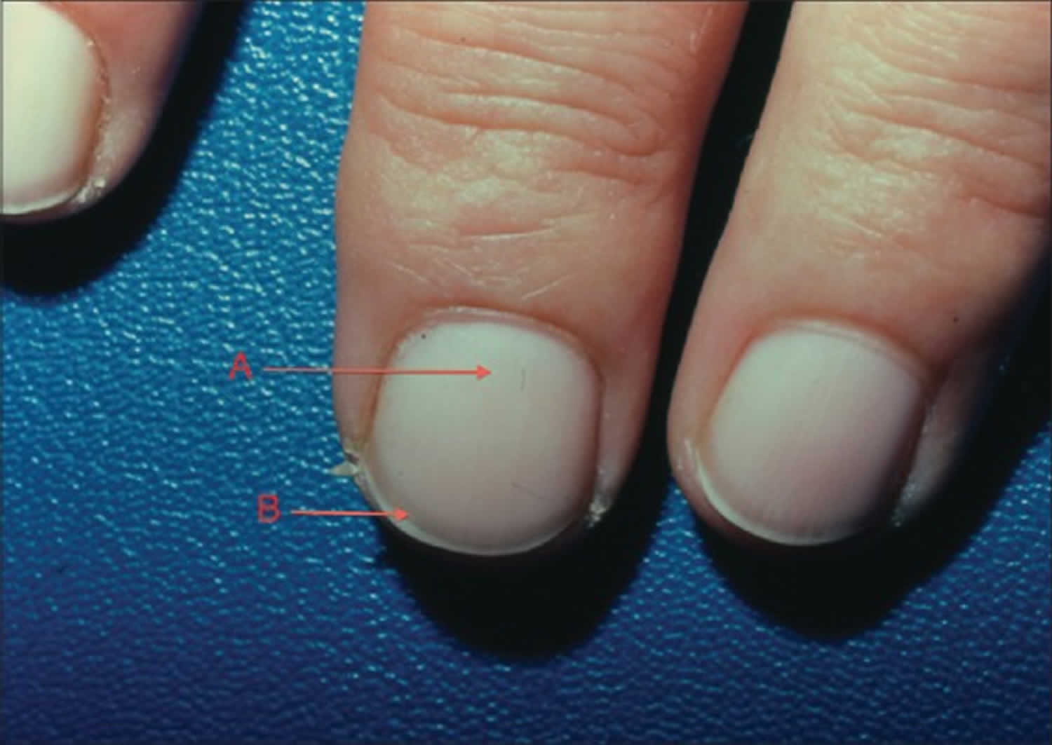 Terry's nails causes, differential diagnosis & treatment