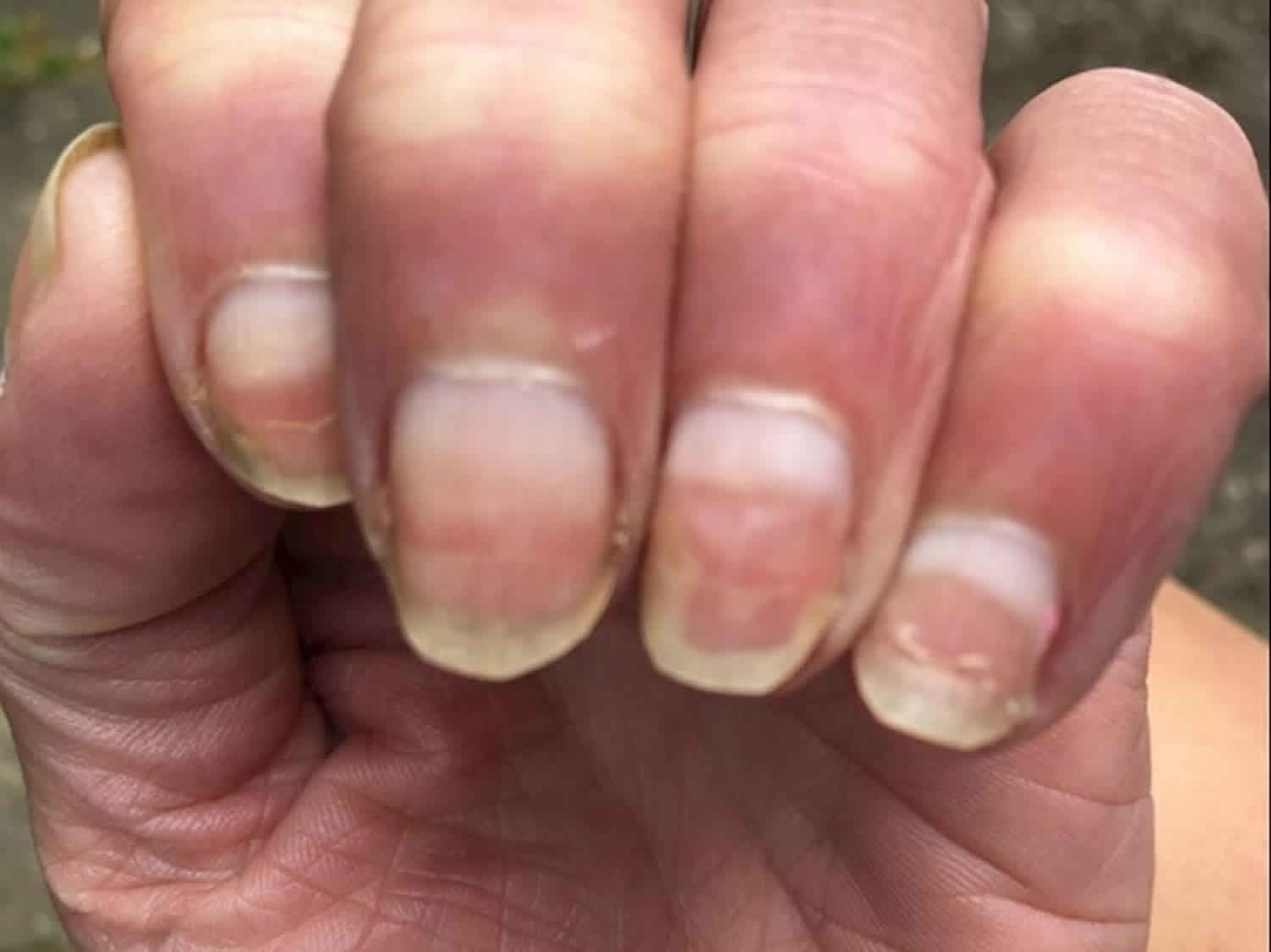 Terry Nails?: Hello - I am an 18 year... - British Liver Trust