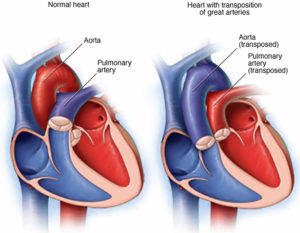 Transposition of the great arteries causes, symptoms, diagnosis ...