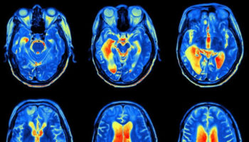 toxic encephalopathy