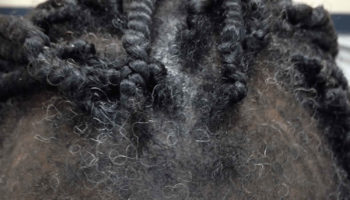 traction alopecia