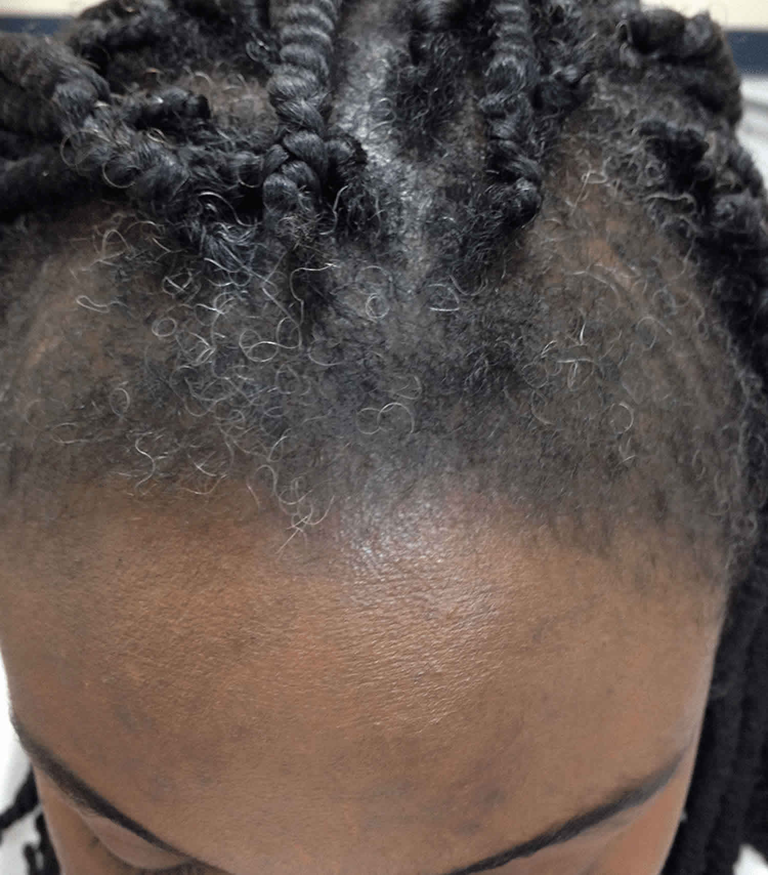 Traction Alopecia Causes Stages Signs Symptoms Diagnosis Treatment