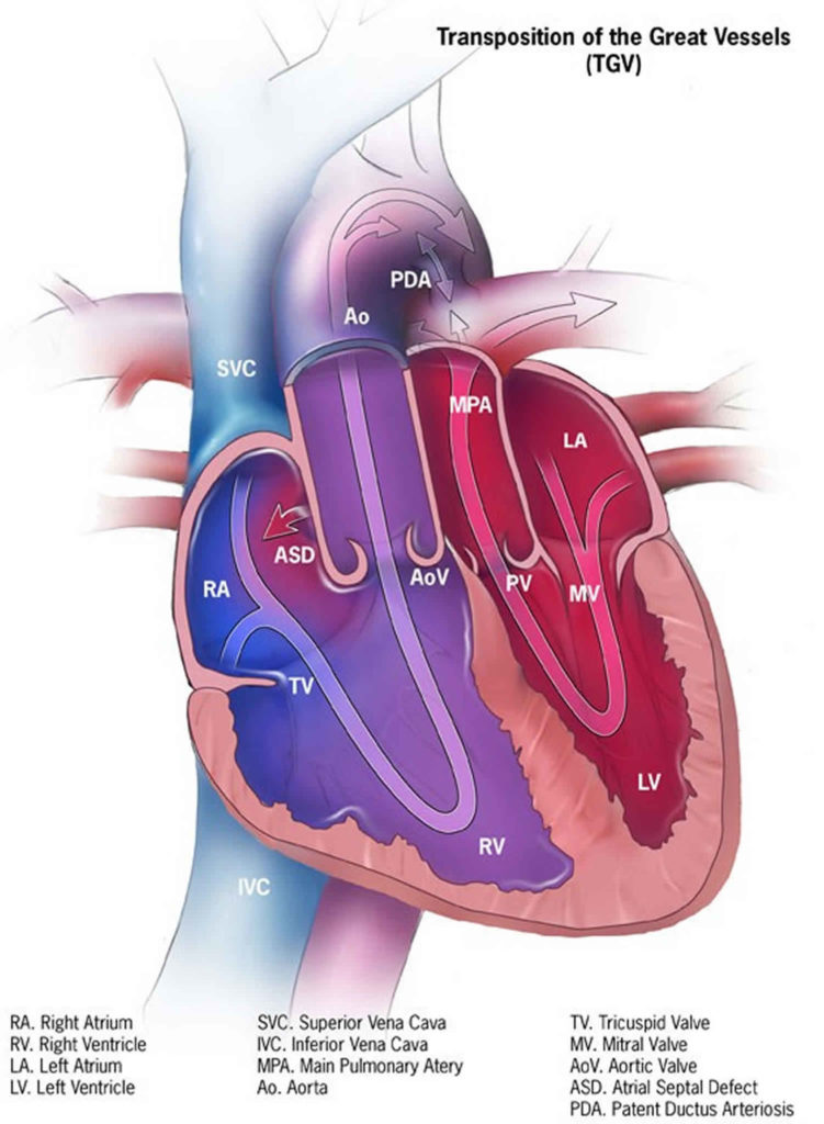 Transposition of the great arteries causes, symptoms, diagnosis