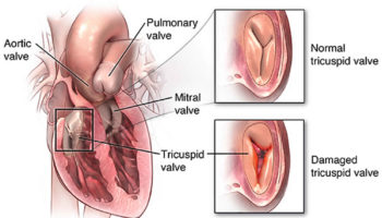 tricuspid stenosis