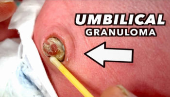 umbilical granuloma