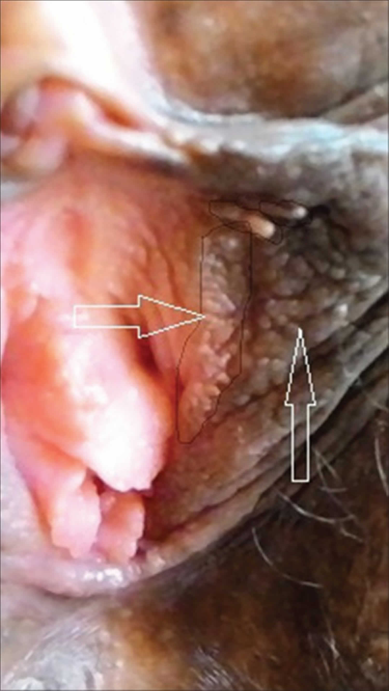 viszket a vestibularis papillomatosis