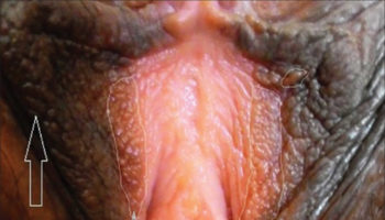 Vestibular papillomatosis