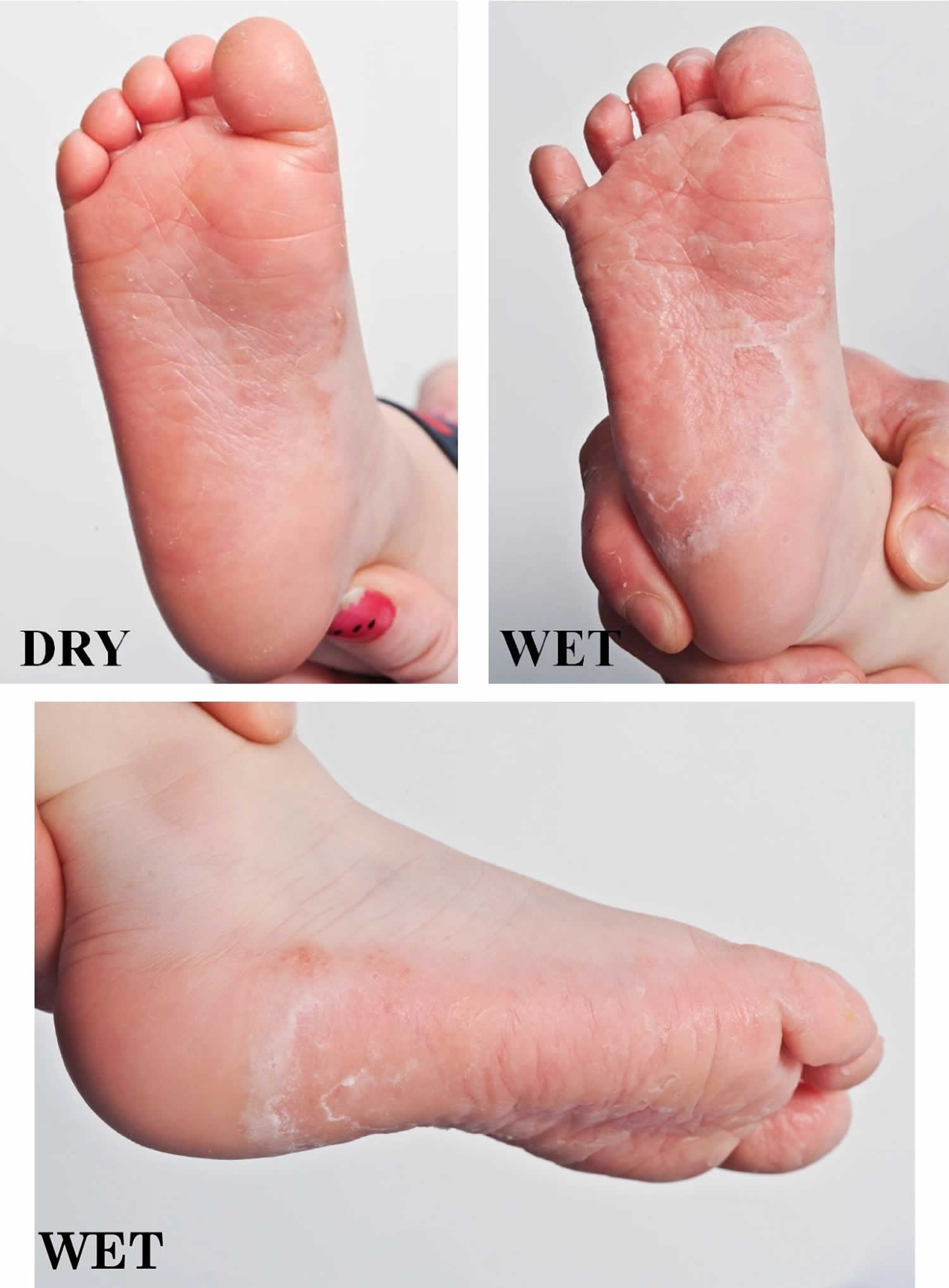 Plantar hyperkeratosis Idea