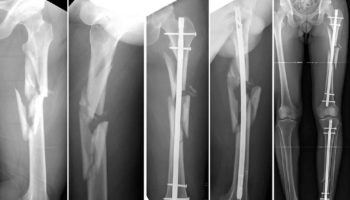 Comminuted fracture