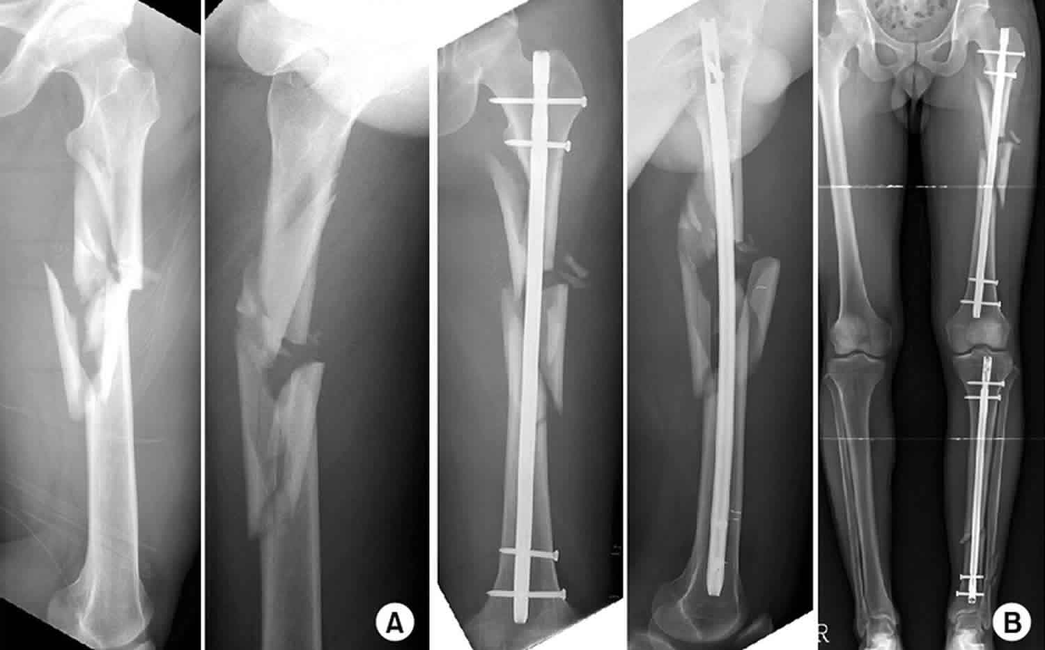 comminuted fracture