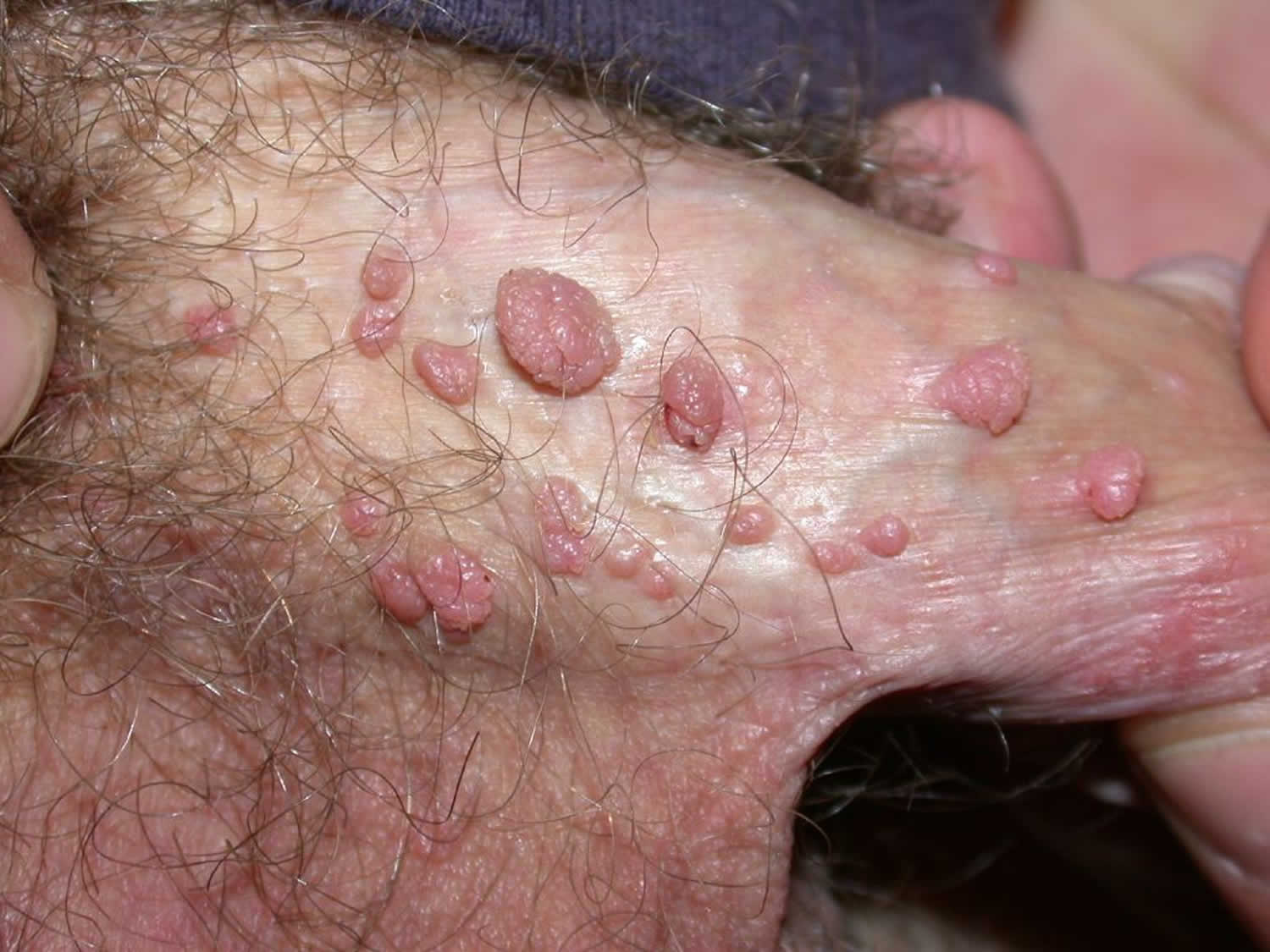 Condyloma molluscum contagiosum. Molluscum contagios tratament