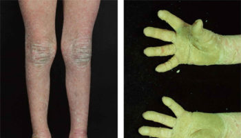 Epidermolytic hyperkeratosis