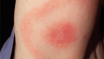 Erythema migrans