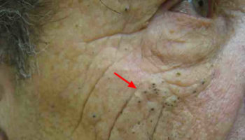 Favre Racouchot syndrome