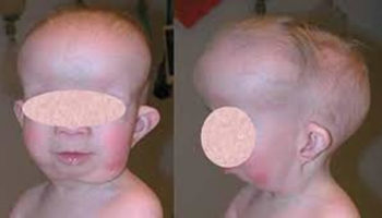 Gorlin syndrome
