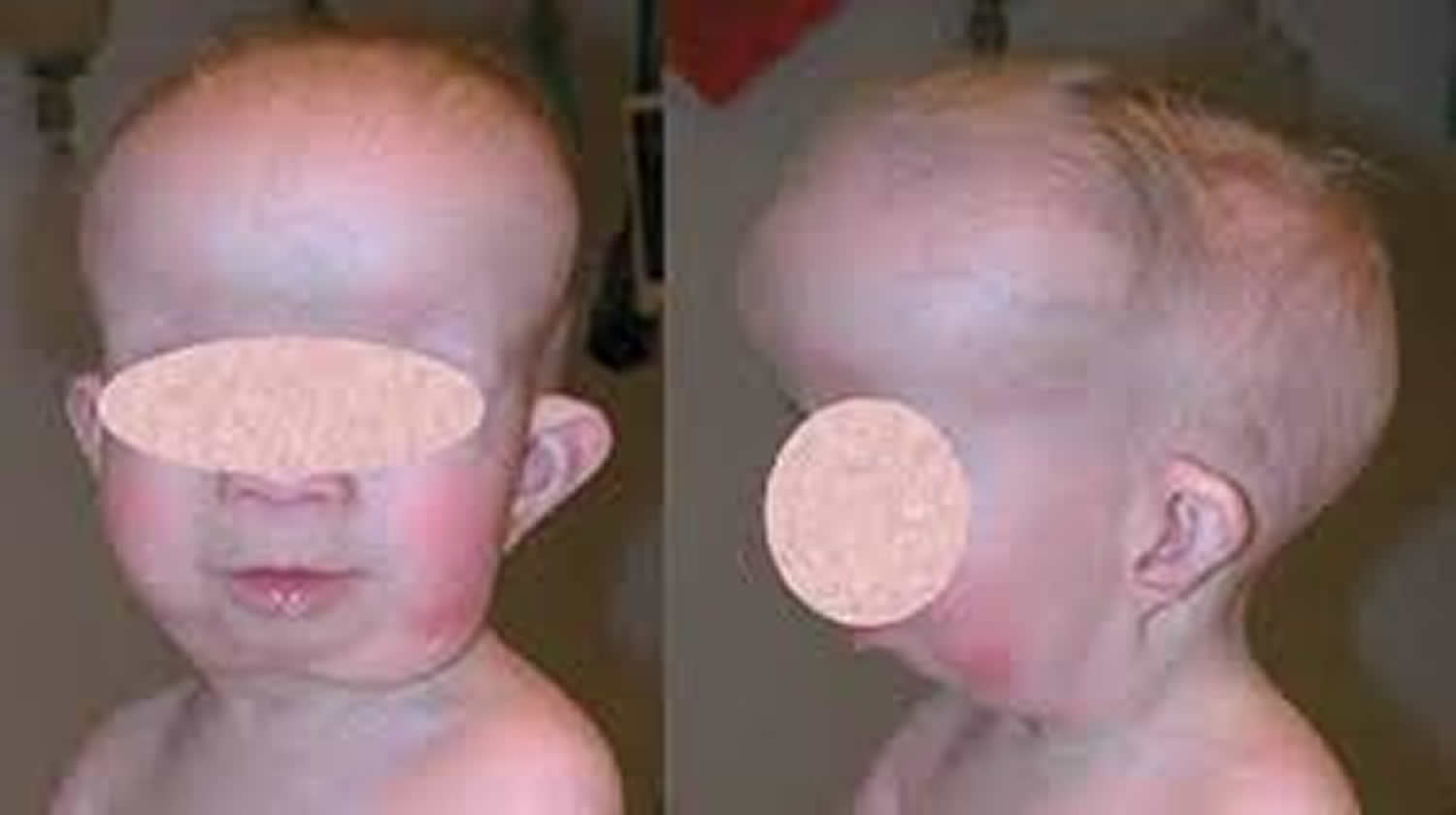 Gorlin syndrome causes, symptoms, diagnosis, treatment & life expectancy