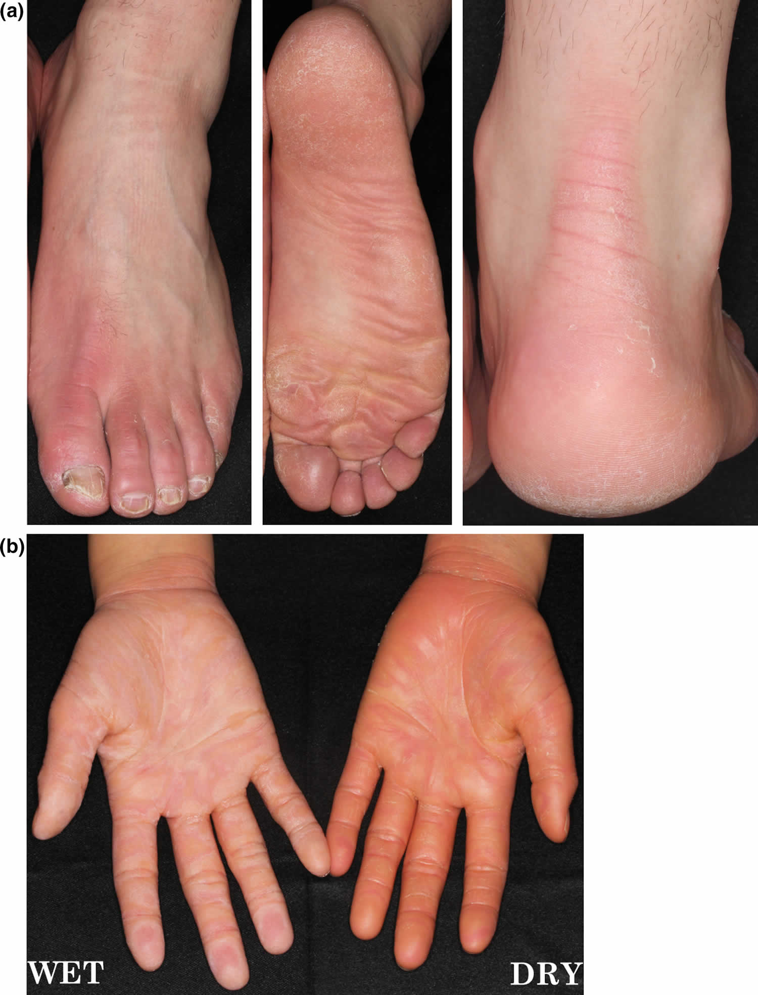 Palmar plantar keratoderma Idea