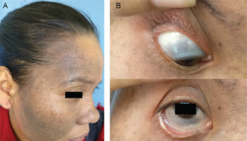 Nevus of Ota