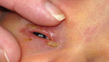 Ophthalmia neonatorum