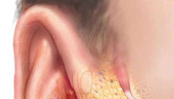 Otitis externa