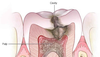 Periapical abscess
