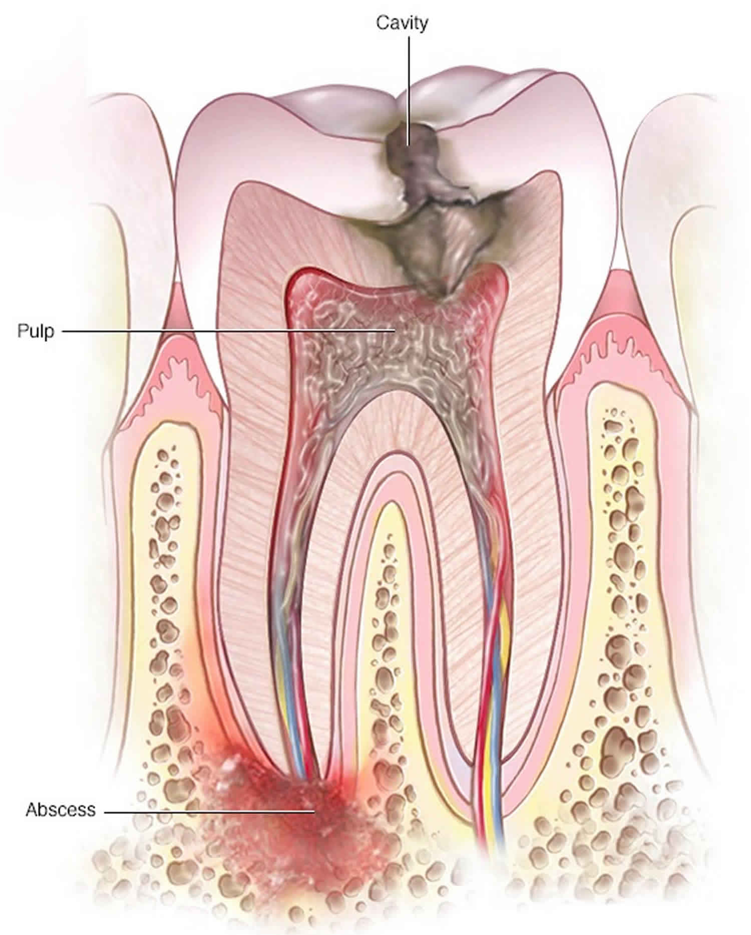 periodontal-abscess-vs-periapical-abscess