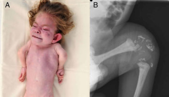 Rhizomelic chondrodysplasia punctata