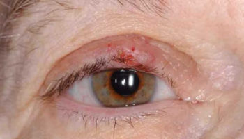 Sebaceous carcinoma