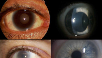 Tangier disease
