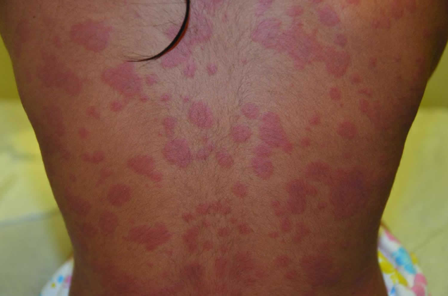 Urticaria And Skin Rashes Signs Causes Treatment Symptoms Images Images