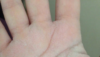 aquagenic keratoderma