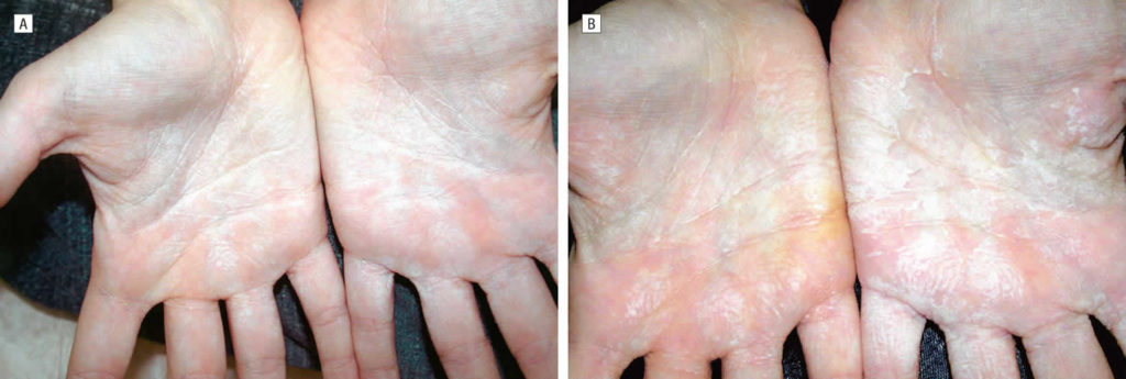 Aquagenic Syringeal Palmar Keratoderma Causes Symptoms Diagnosis