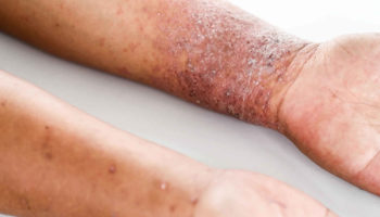 atopic dermatitis
