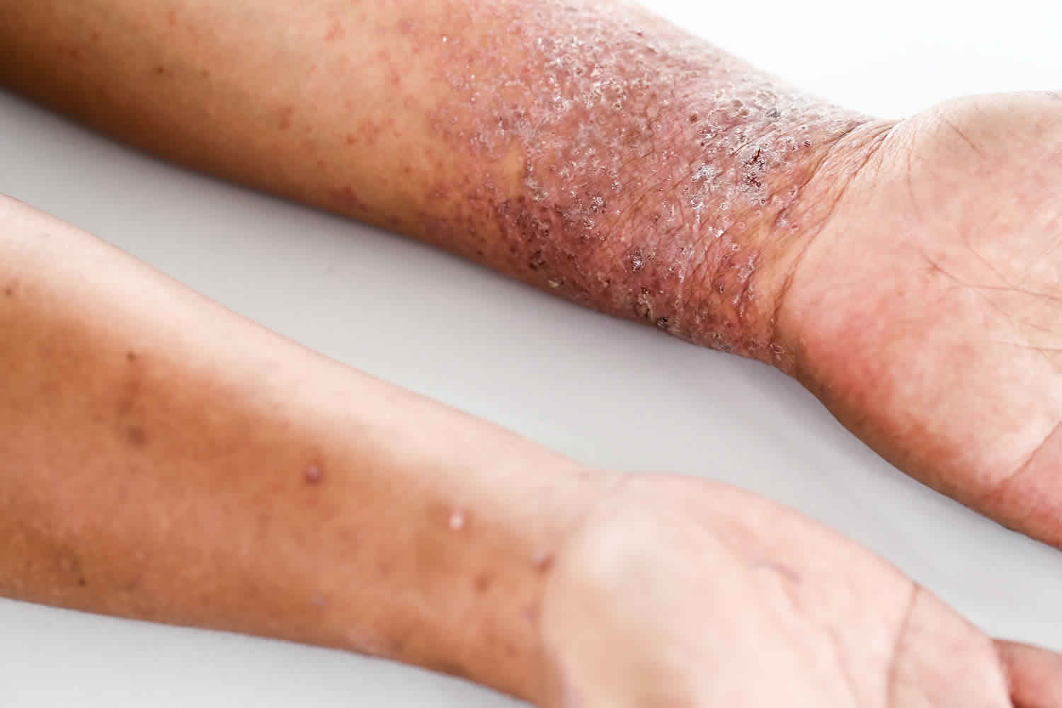 patient journey in atopic dermatitis the real world scenario