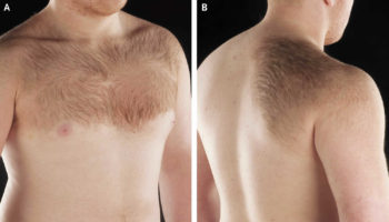 becker melanosis