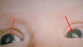 congenital rubella syndrome