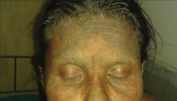 dermatitis neglecta