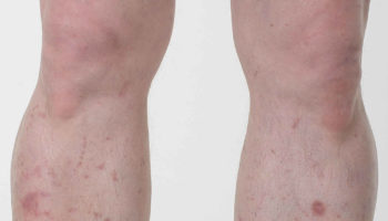 diabetic dermopathy