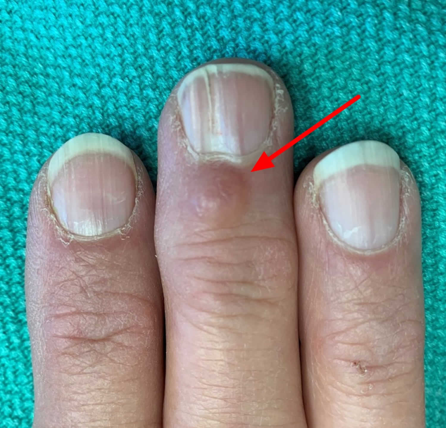 Cyst Under Nail Bed