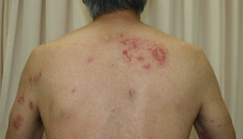 disseminated herpes zoster