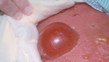 edema blister