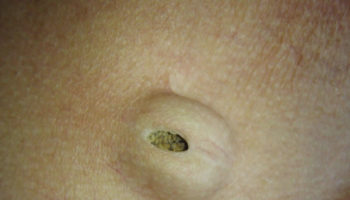 epidermal cyst