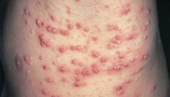 eruptive xanthoma