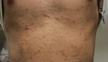 eruptive vellus hair cysts