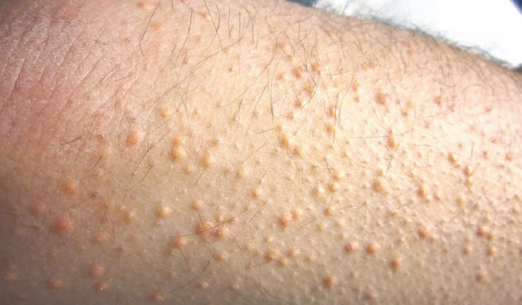 Eruptive xanthoma causes, symptoms, diagnosis & treatment