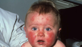 erythema infectiosum